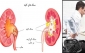 درمان سنگ کلیه